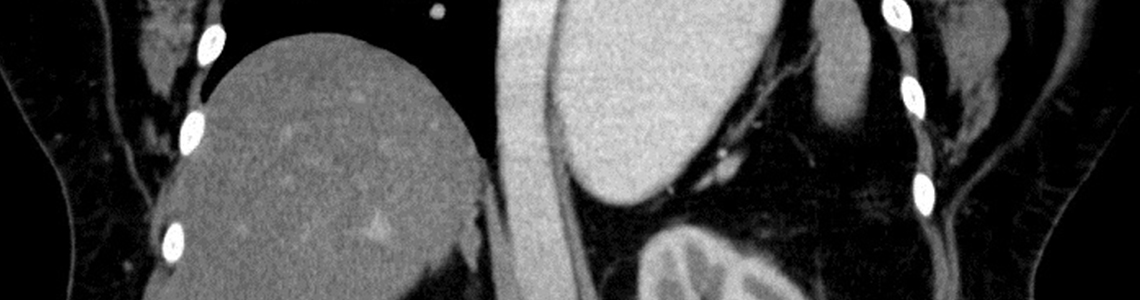 Gammakamera Computertomographie Aufnahme