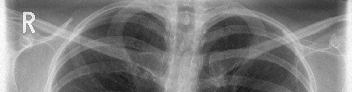 Röntgenaufnahme des Brustkorbs